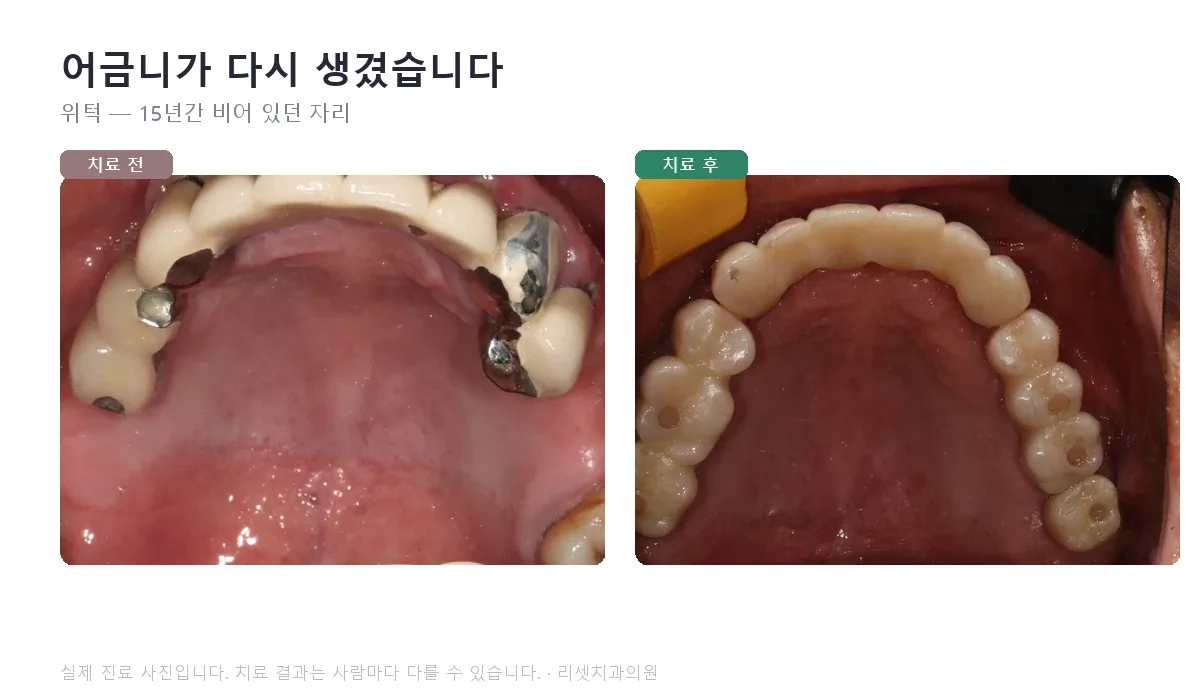 위턱 — 15년간 비어 있던 자리입니다