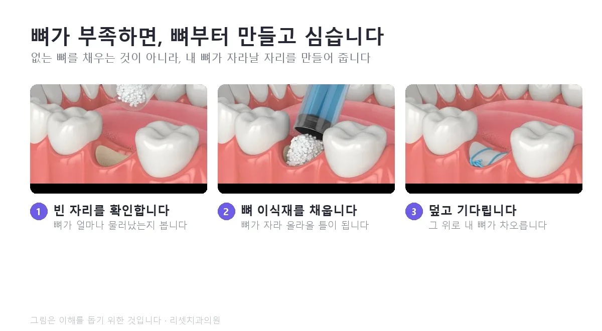 뼈이식 과정 — 빈 자리 확인, 뼈 이식재 채우기, 덮고 기다리기