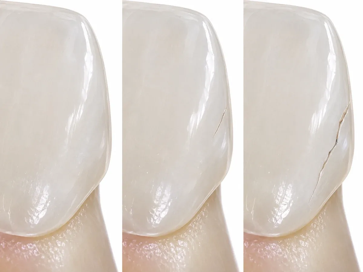 Three close-ups of the same spot on a thin porcelain shell: first a smooth, unbroken surface; then a hairline crack that has not yet reached the edge; then the crack grown longer and branching to the edge, with one corner about to lift off — Reset Dental Clinic