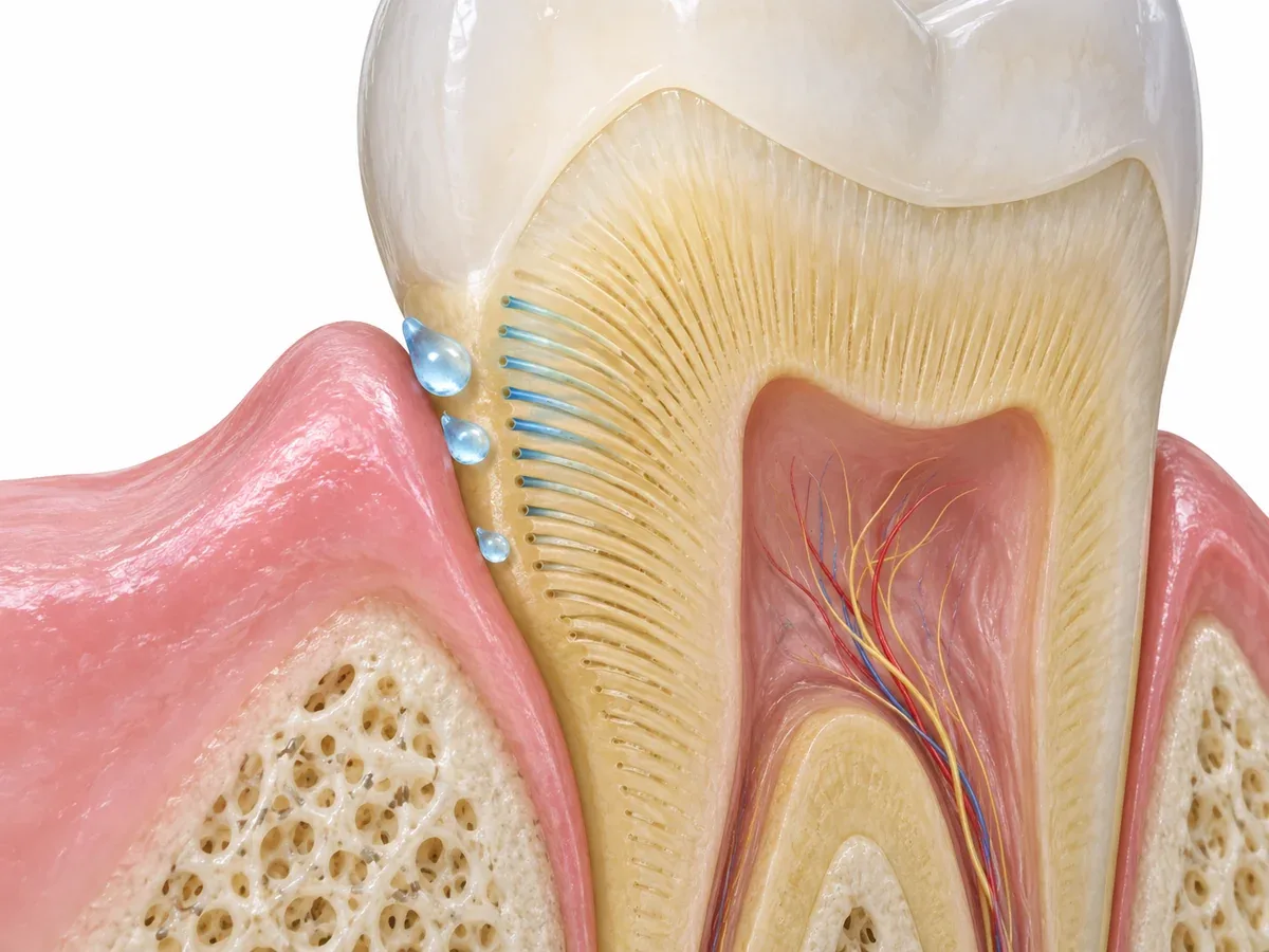 Close-up cross-section showing cold stimuli travelling along the fine tubes of exposed dentin toward the nerve after the enamel has worn — Reset Dental Clinic