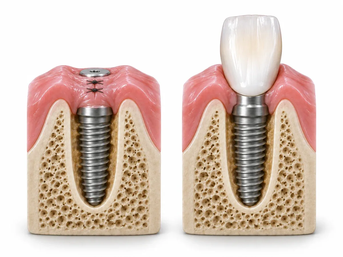 Placing the implant is usually possible. Whether to fit a tooth on it is a separate decision.