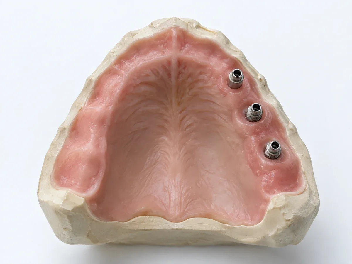 An upper jaw model with implants placed on one side alone — Reset Dental Clinic