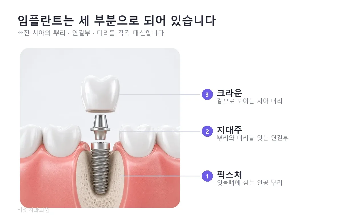 임플란트 구조 — 잇몸뼈에 심는 픽스처, 연결부인 지대주, 겉으로 보이는 크라운