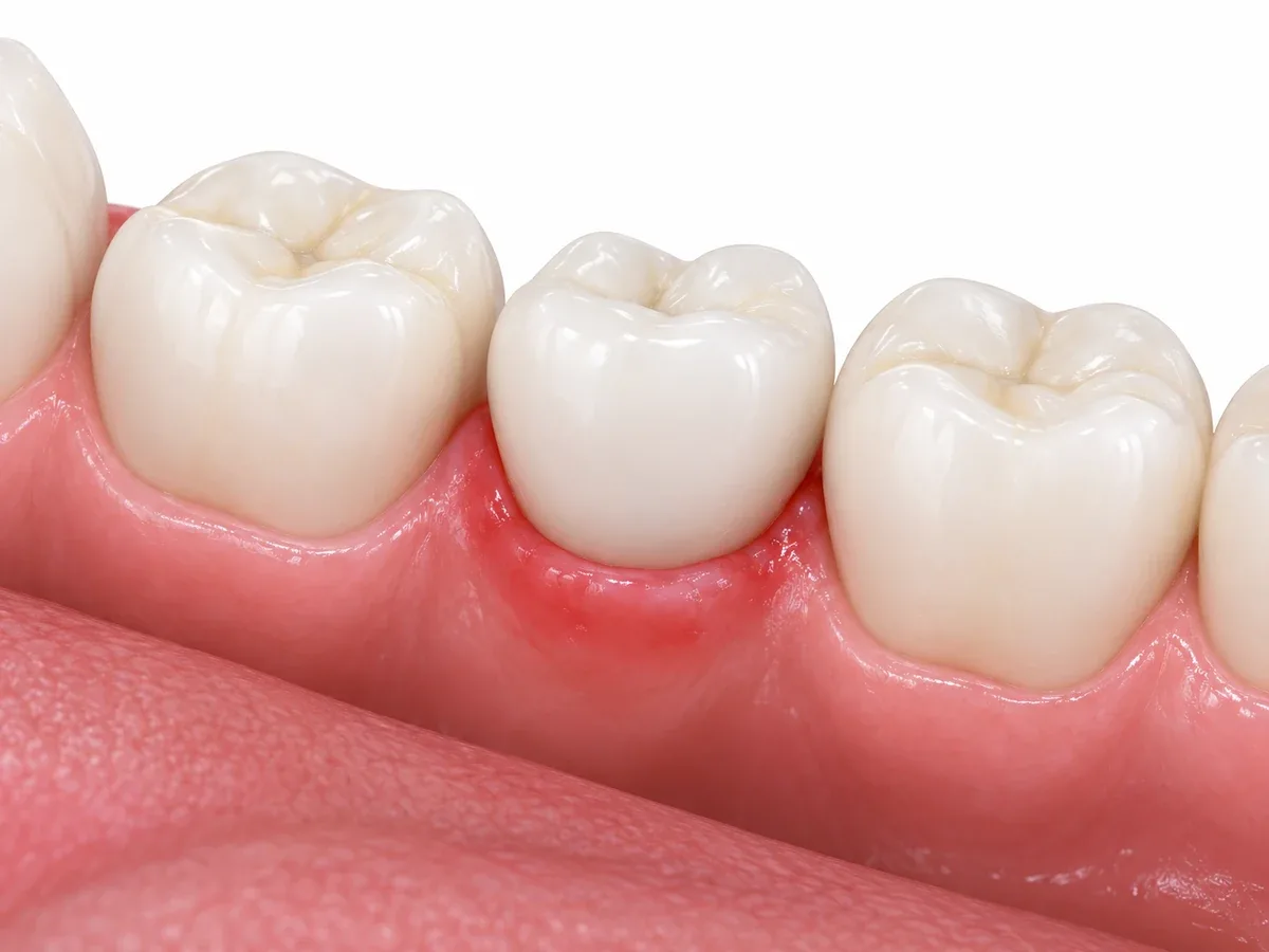 Even without pain, the gum around an implant can be inflamed.