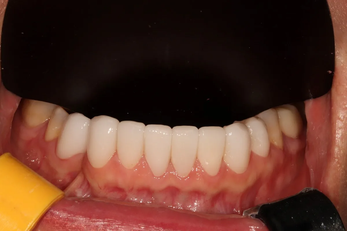 치료 후