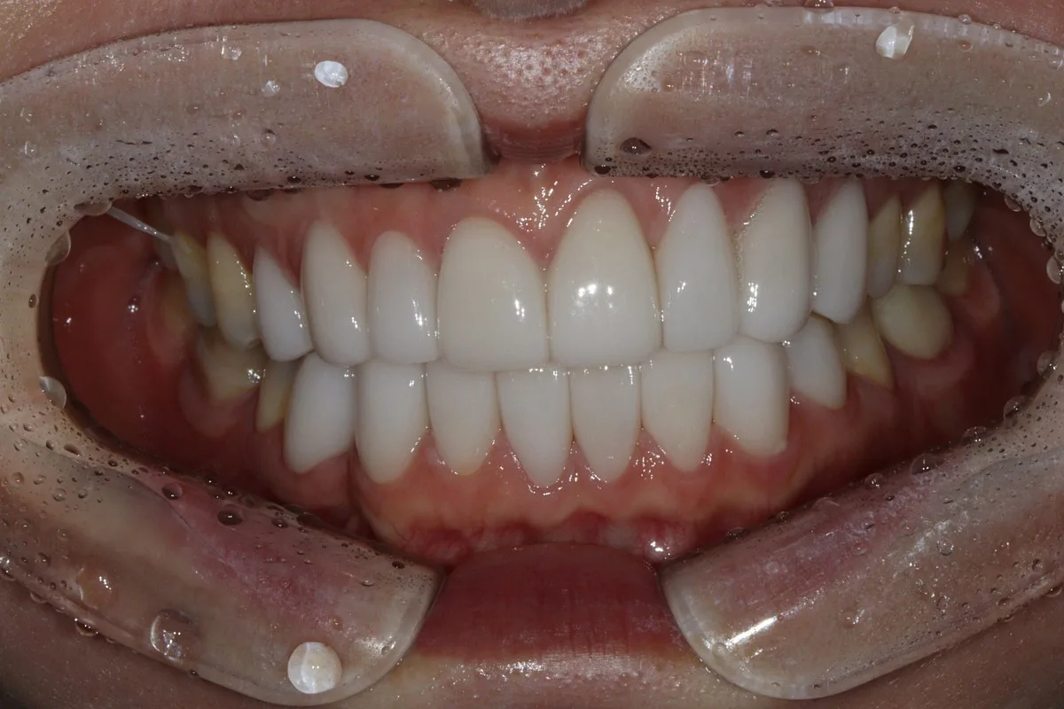 치료 후