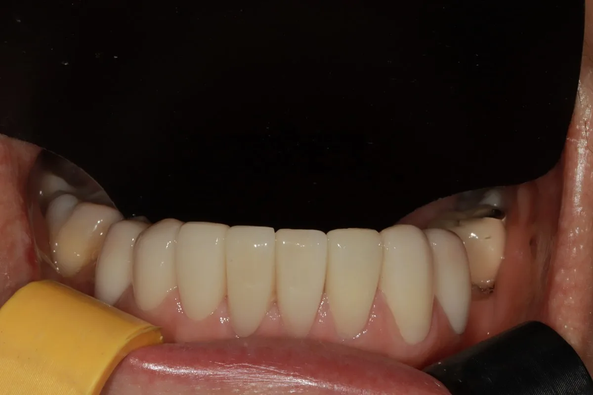 치료 후