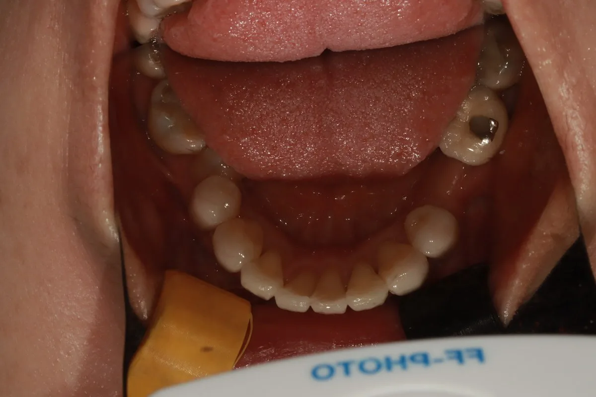 치료 후