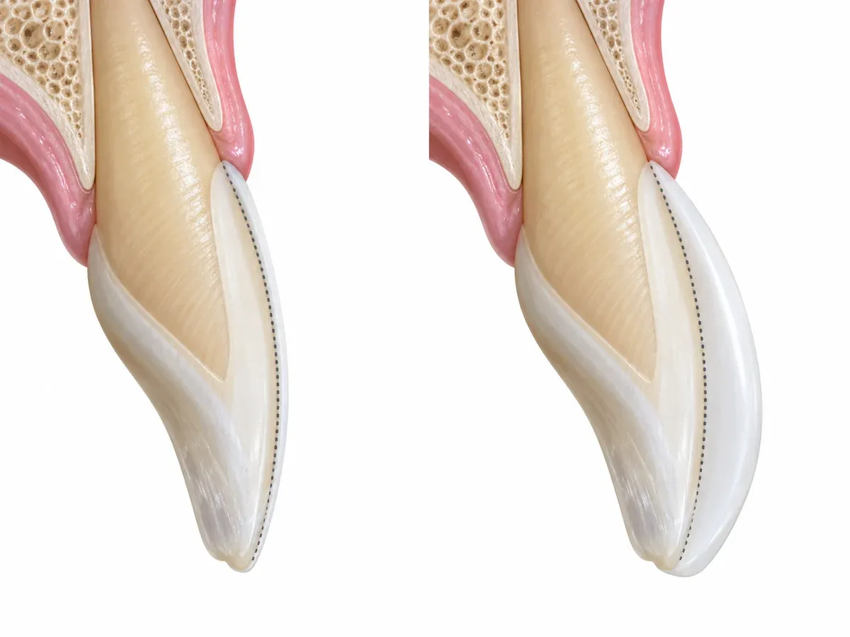 Bonded thickness does not disappear. All of it is added to your profile.