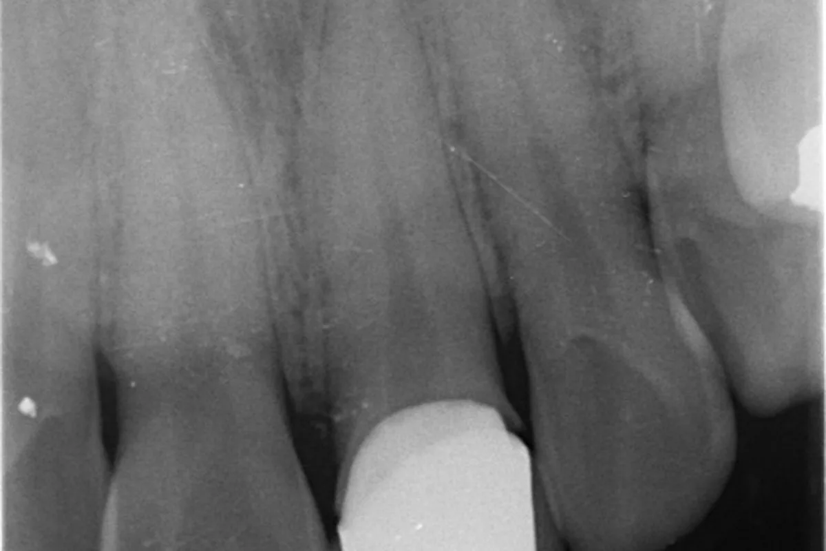 X-ray — 신경치료를 마치고 크라운을 씌운 상태