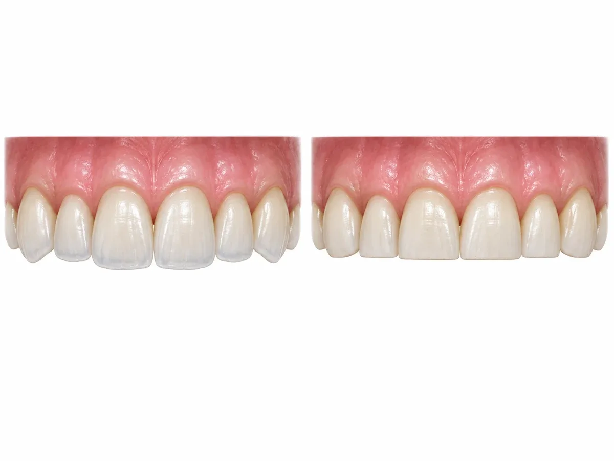 Two front views of four upper front teeth: on the left, the edges are gently rounded and the two central teeth sit slightly longer, forming a soft curve; on the right, the edges are worn flat to the same short height, thin at the tips and slightly chipped — Reset Dental Clinic